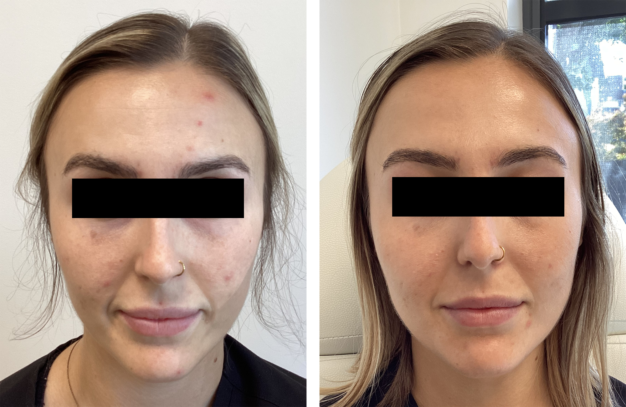 Surviving Stress and Breakouts: Your Guide to Tackling Acne in College