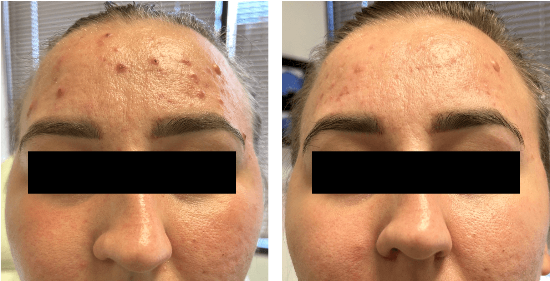 Understanding the Gut-Skin Connection: How Gut Health Affects Acne-Prone Skin