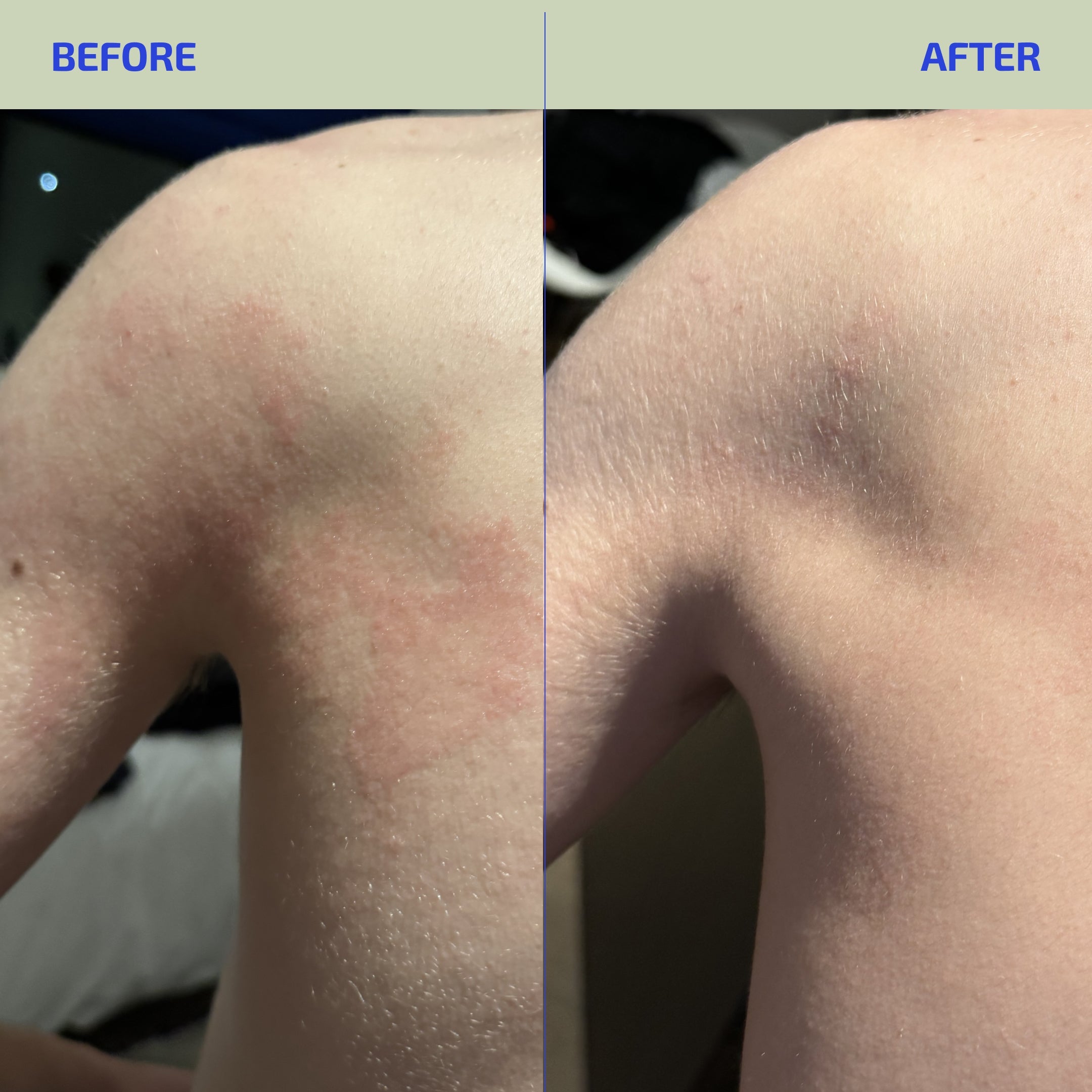 Before and after comparison of a shoulder with redness.
