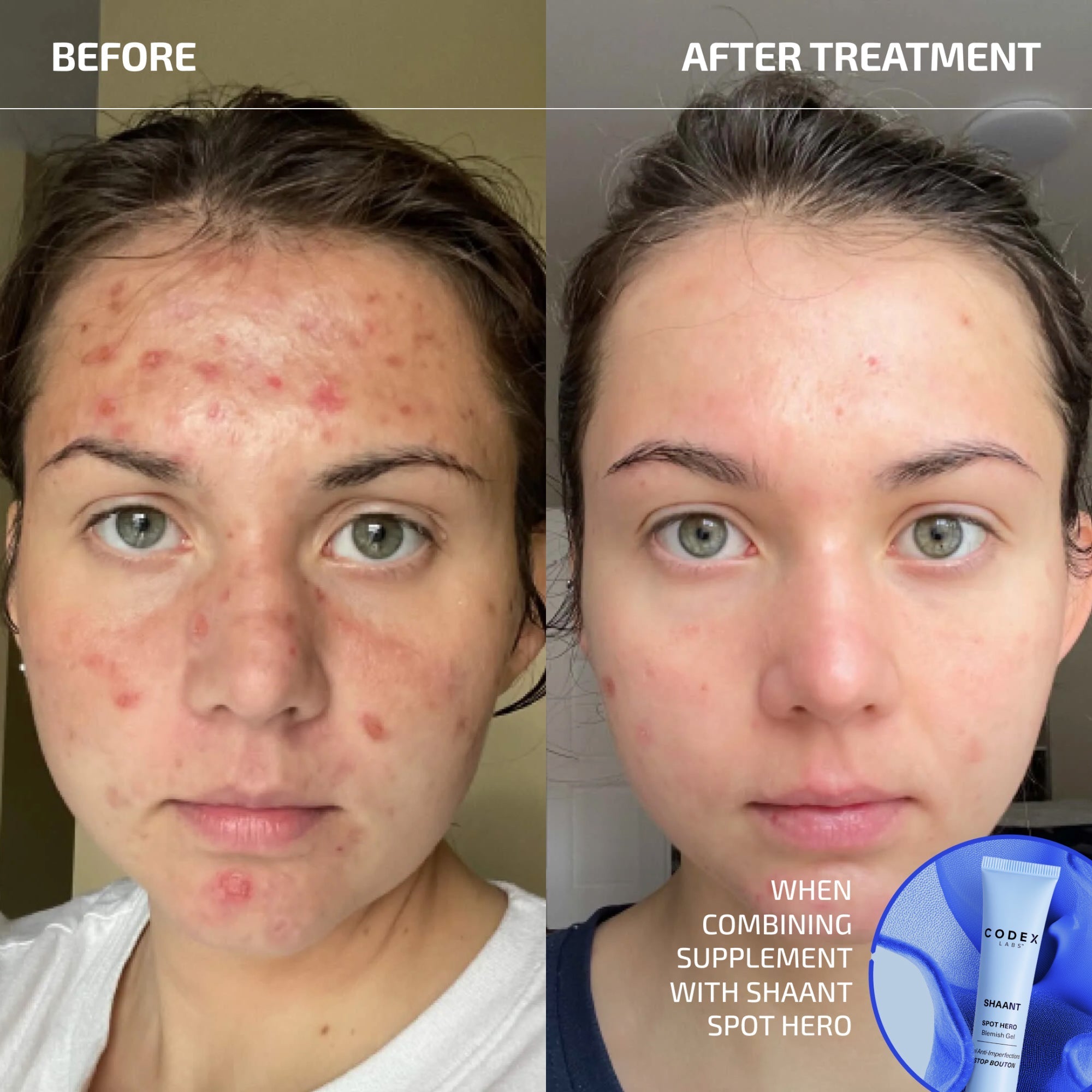 Shaant ClearSkin Probiotic Supplement 2.0