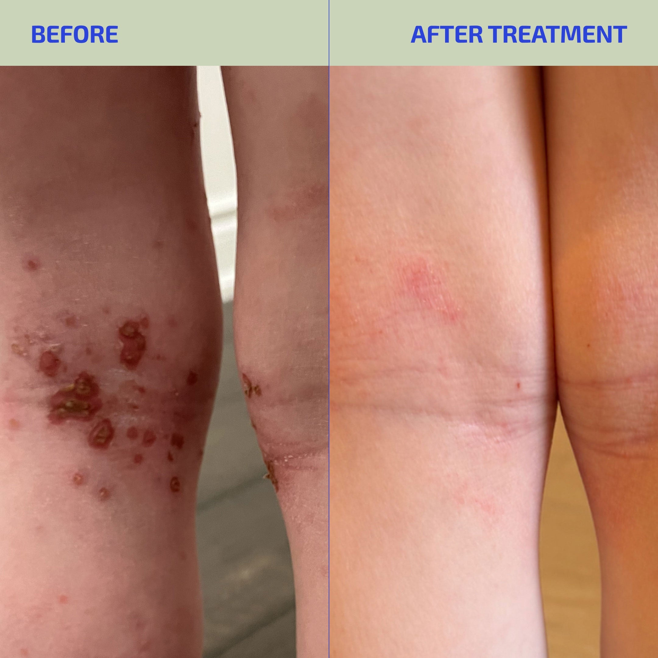 Before and after treatment comparison of skin conditions on a person's leg.