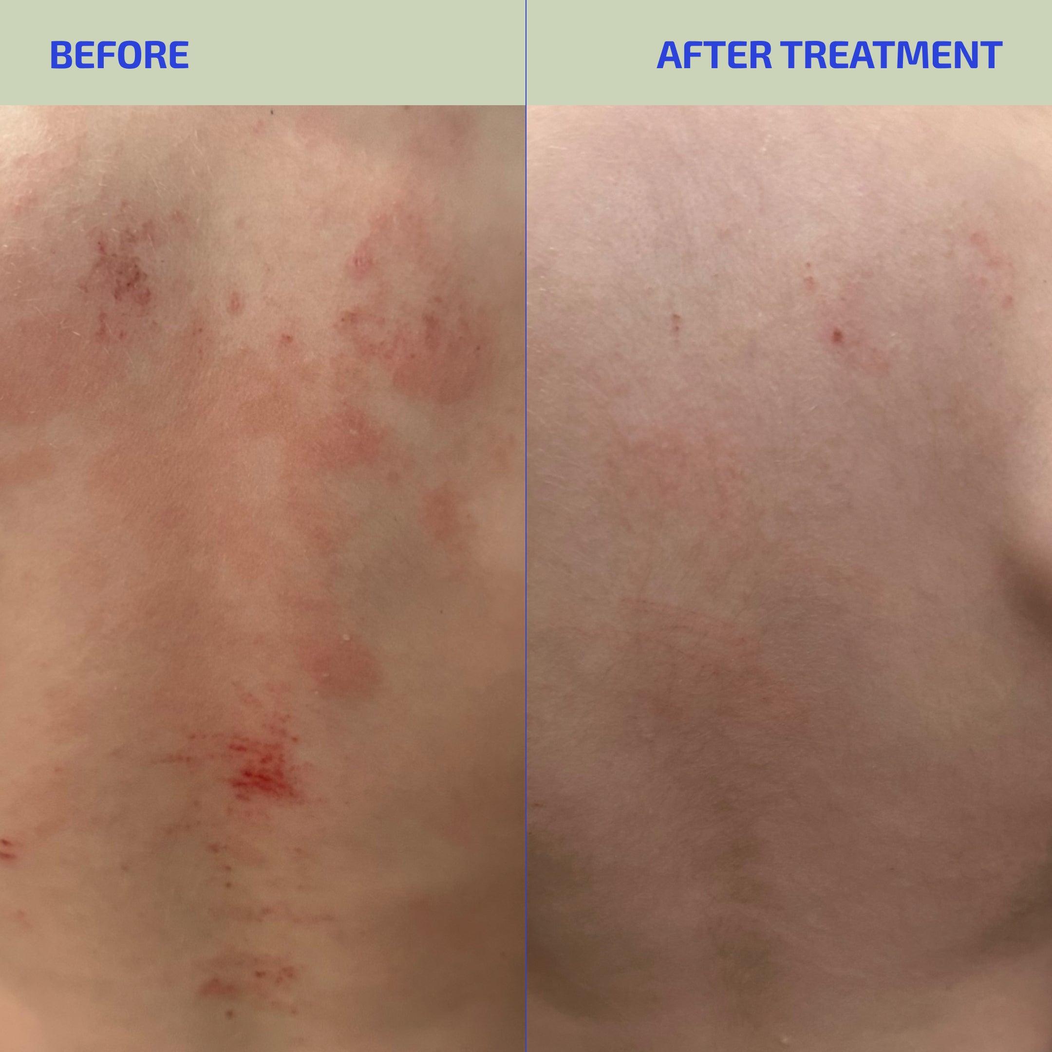 Skin Barrier Eczema-Prone Relief System (Teen: 13-18)