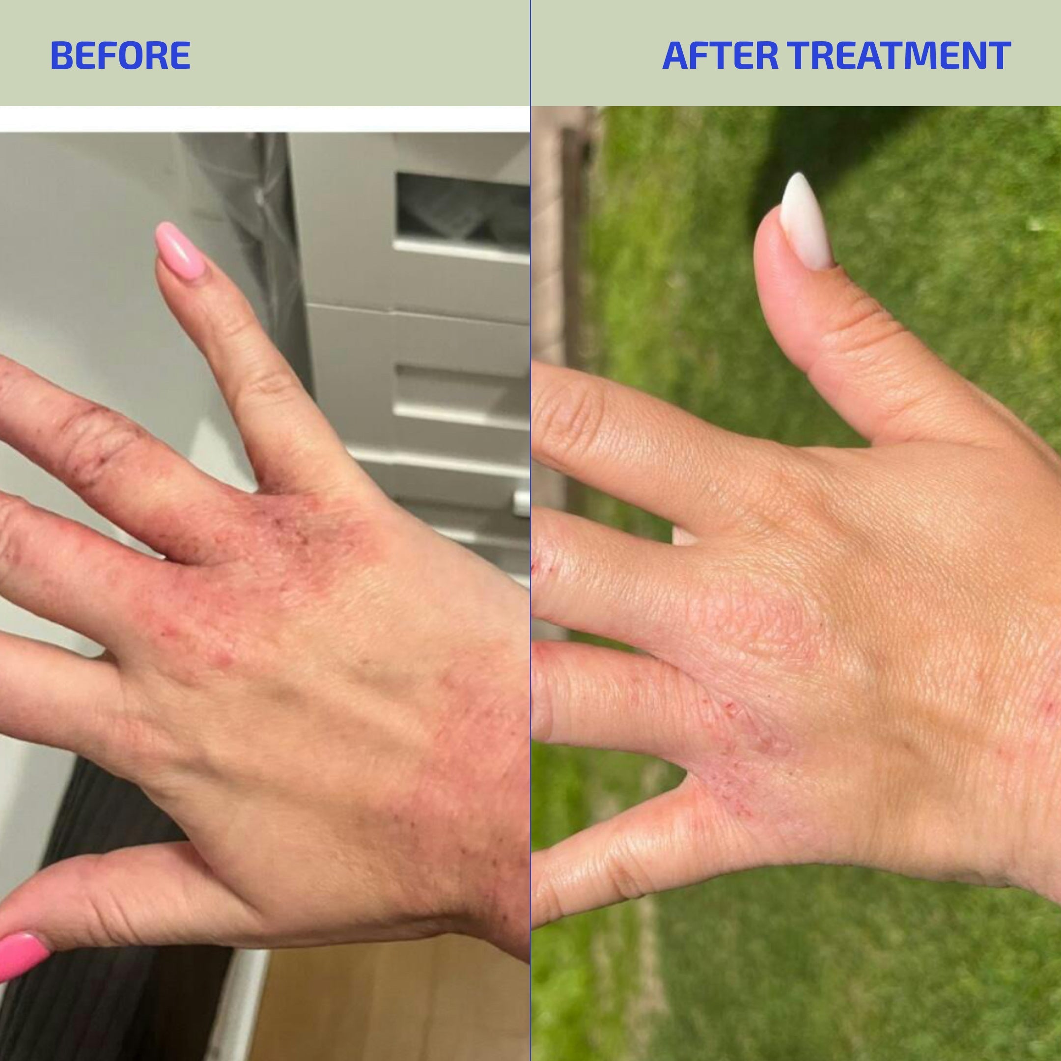 Before and after treatment comparison of a hand with visible skin issues.