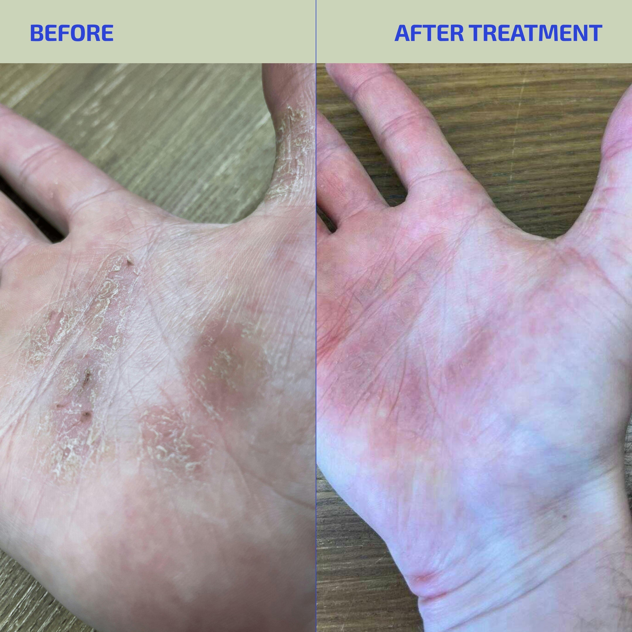 Gut & Skin Barrier Support Bundle – Prebiotic + Probiotic for Eczema-Prone Skin (Age: 12+)