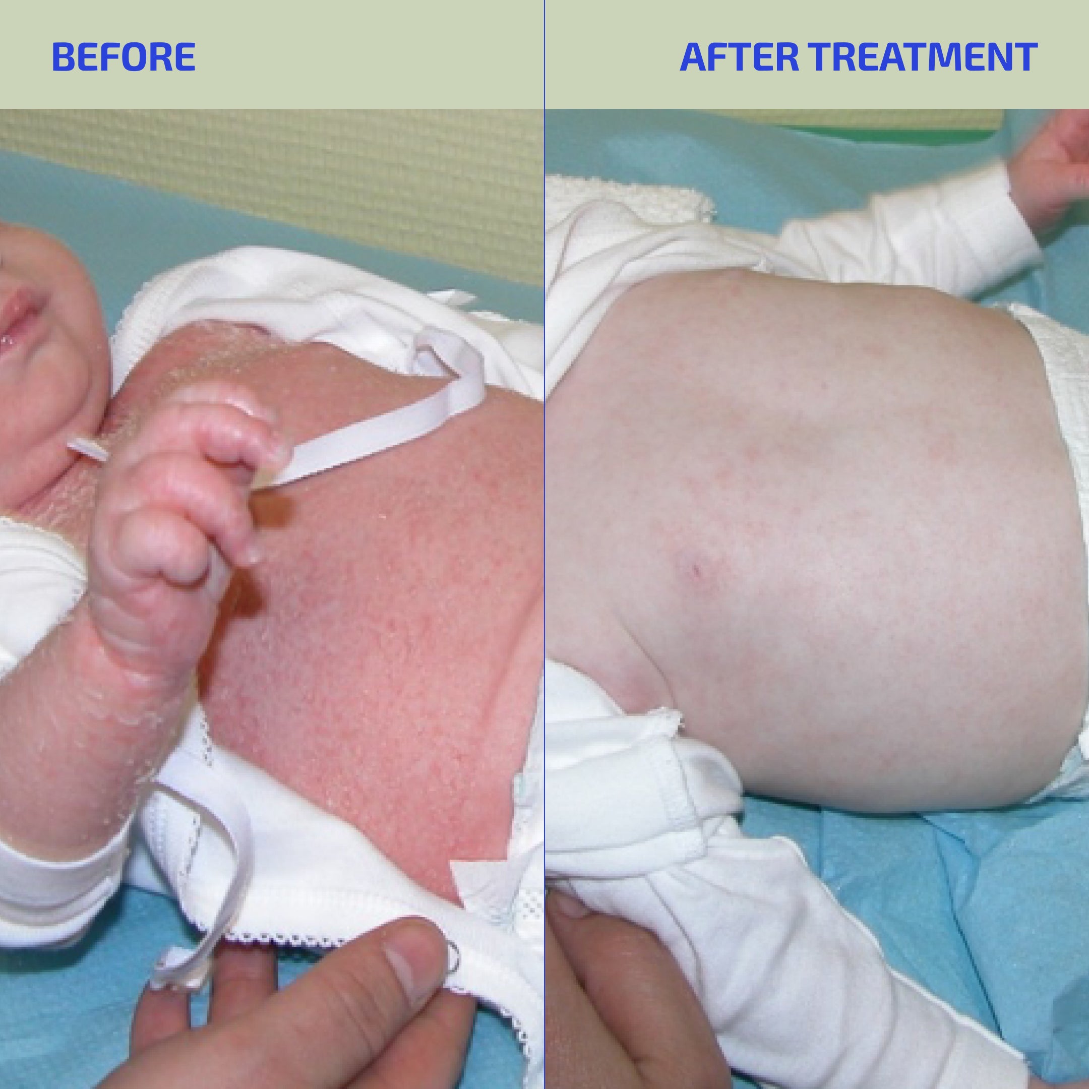 Skin Barrier Eczema-Prone Relief System (Toddler: 1-3)