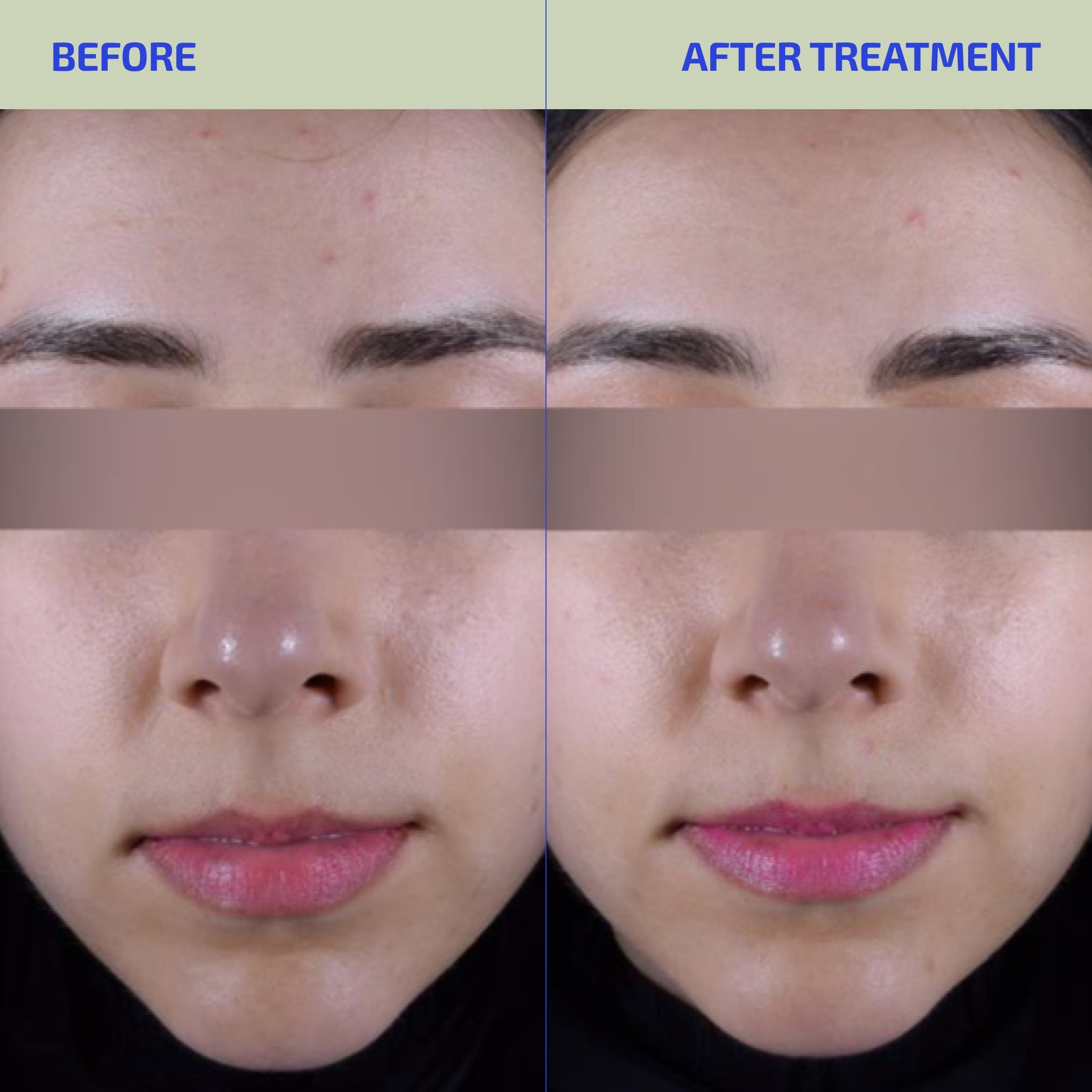 Before and after treatment comparison of a person's face with visible skin improvement.