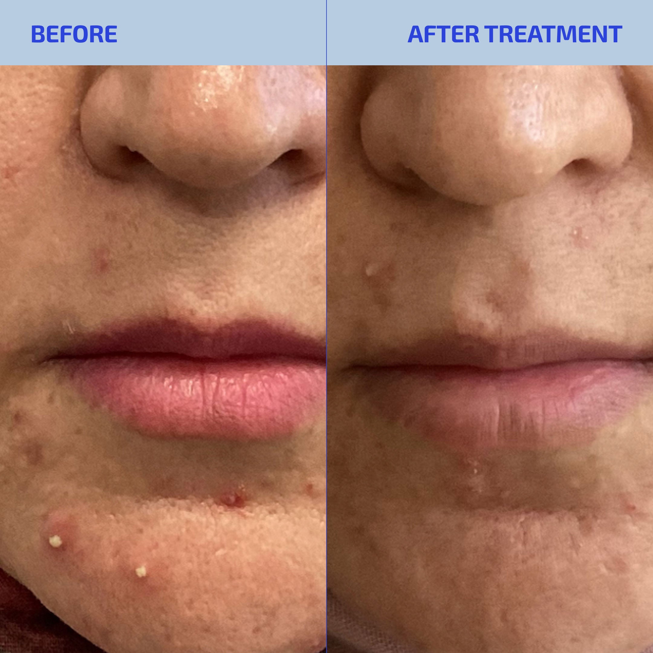 Hormonal Acne System