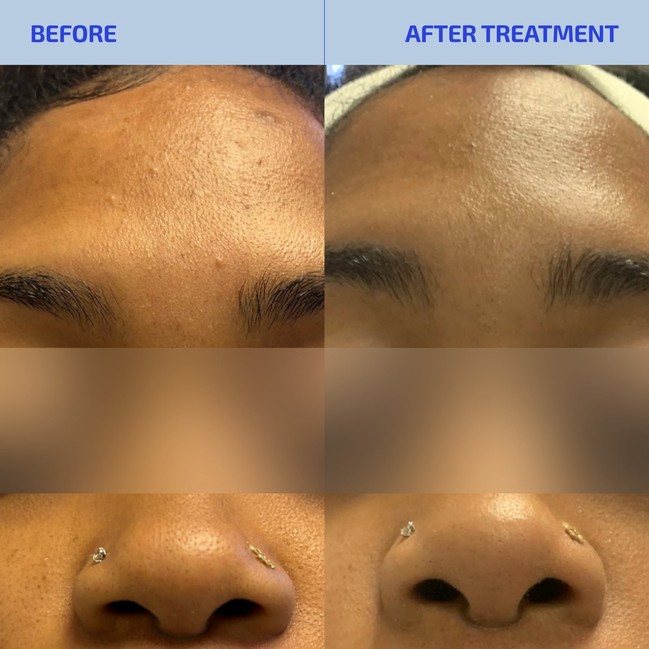 Balancing Clay Mask for Oily & Acne-Prone Skin – SHAANT 100 gm