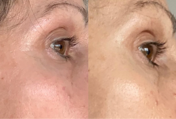 Before and after image of a persons eye and cheek and a progression of their skin clearing up